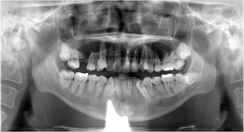 田村3　埋入前 抜歯後約6ヶ月